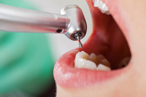 Best Emergency Wisdom Teeth Removal in Lake Shore, WA